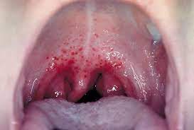 strep throat symptoms causes and