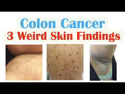 3 weird signs of colon cancer found on