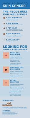 how to spot skin cancer infographic