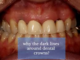 Dental Crowns With Dark Lines B I C Dental Implants