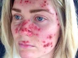 woman s skin cancer selfies go viral