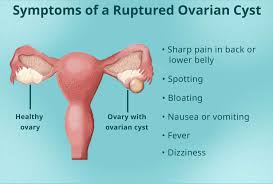 ovarian cyst rupture pain symptoms