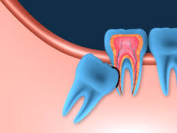 However, more complex situations (such as wisdom teeth that are close to your nerve, or have curved roots that are difficult to remove) may need to be referred to an. Wisdom Teeth Removal Options Procedure Cost