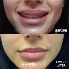 0 5ml and 1ml lip fillers injections