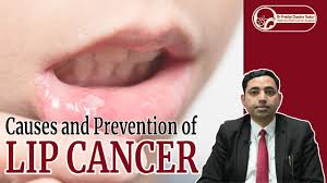 lip cancer symptoms and causes