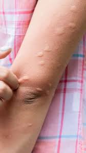home remes for fungal infections