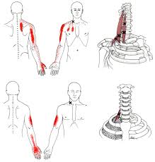 Scalene The Trigger Point Referred Pain Guide