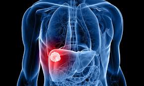 best liver cancer treatment hospital in