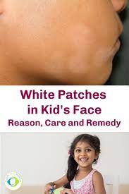 white patches in kids face reason