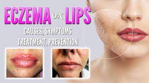 eczema on lips causes treatment