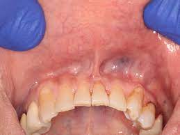 frenectomy and how much is frenulum surgery
