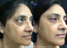 microneedling treatment for face in