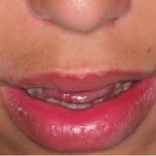 persistent lip swelling