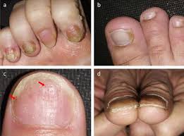 nail bed in nail psoriasis