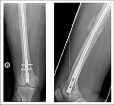 femur treated with im nail