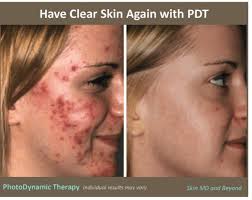 pdt frisco tx acne treatment