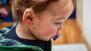 Michelle clark, md and hillary b. Baby Allergic Reaction To Food Signs And Symptoms