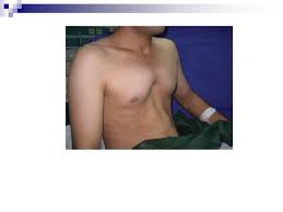 It is the most sought after medical procedure in which plastic surgery is performed to rebuild the chest wall and properly graft the ribs into appropriate places. Chest Wall Tumors And Congenital Chest Wall Malformations
