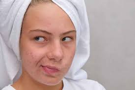 cystic acne causes symptoms