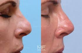 non surgical rhinoplasty before after
