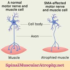 what is spinal muscular atrophy sma