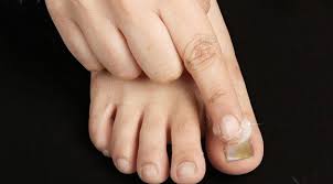 home remes for nail fungus infection