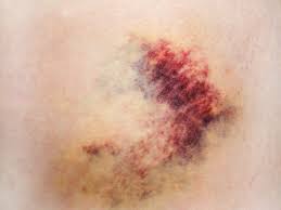 And actinic purpura, because of its association. Idiopathic Thrombocytopenic Purpura 6 Signs Of This Rare Disorder Self