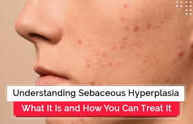 understanding sebaceous hyperplasia