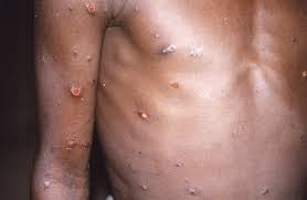 Monkeypox And Where Is It Spreading ...