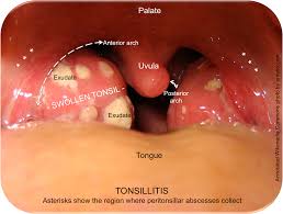 peritonsillar abscess quinsy