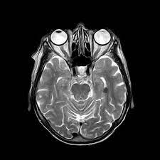 mri scans without contrast