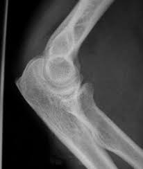 Maybe you would like to learn more about one of these? How To Read An Elbow X Ray Emergency Medicine Education Newyork Presbyterian