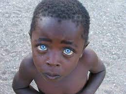 Чудо природы – 17 чернокожих детей с голубыми глазами - onedio.ru