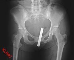 Image result for Radiology concrete crack