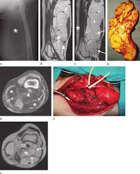well diffeiated liposarcoma of the