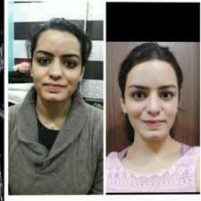 Instead of using concealers and tinted moisturizers, you could make lifestyle changes, focus on your blend tomato with lemon juice and honey. Facial Hyperpigmentation And Uneven Skin Tone By Dr Niharika Chugh Lybrate
