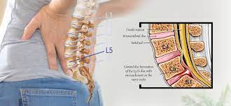 l5 s1 disc bulge slip disc stenosis