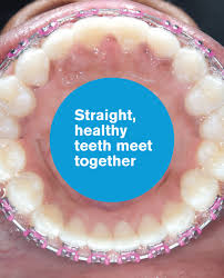 Depends on how big the gaps are. Gaps Between Teeth Before And After Braces Viechnicki Orthodontics