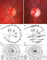 Ophthalmologic diagnosis of ADOA. Results of an ADOA patient bearing an...  | Download Scientific Diagram