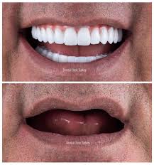 full mouth dental implants full mouth