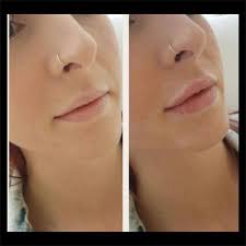dermal lip filler before and after at