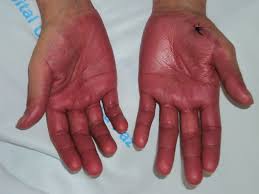 Palmar erythema, often called liver palms, is reddening in both of the palms. Acral Erythema Worsened By Intravenous Infusions Of Cyclosporine