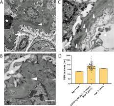 Cd151 Associated Glomerular Disease