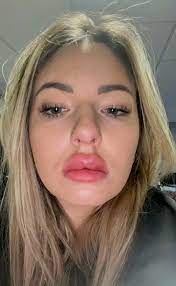 i spent 650 on lip fillers to create a