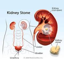 Kidney Stones Pain Symptoms Causes Passing A Kidney