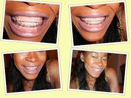 However, they should be avoided with braces because of some problems. 109 My Teeth Whitening Methods Even With Braces On Youtube