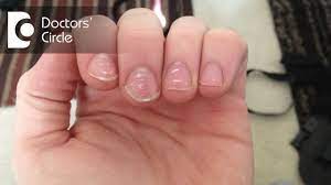 what causes white spots on nails and