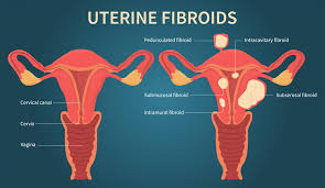 beginner s guide to uterine fibroids