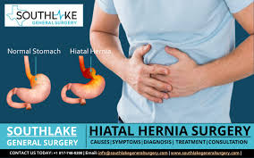 hiatal hernia surgery at southlake