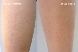 laser hair removal treatment in marina